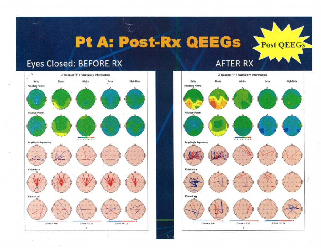 QEEG Analysis Brain Mapping - Patient A 1024x792 